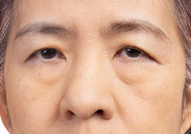 眼瞼下垂