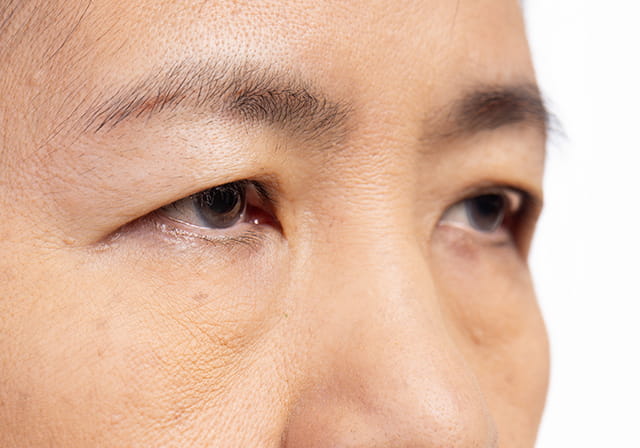 眼瞼下垂手術